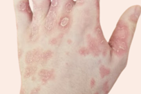 Erythrodermic psoriasis 2 - An image of erythrodermic psoriasis on hand with hospital admission tag