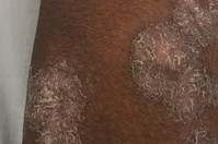 Plaque Psoriasis Image 2