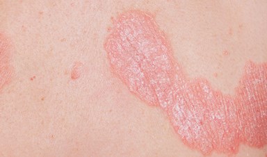 Plaque Psoriasis Image 2