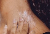TJ - Applying Treatments